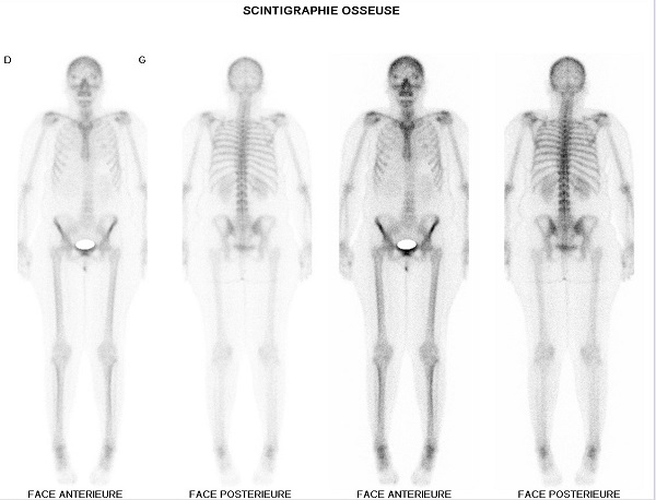 Scintidôme | La scintigraphie osseuse